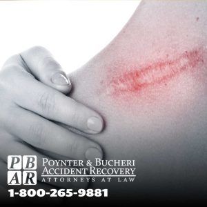 scar on shoulder